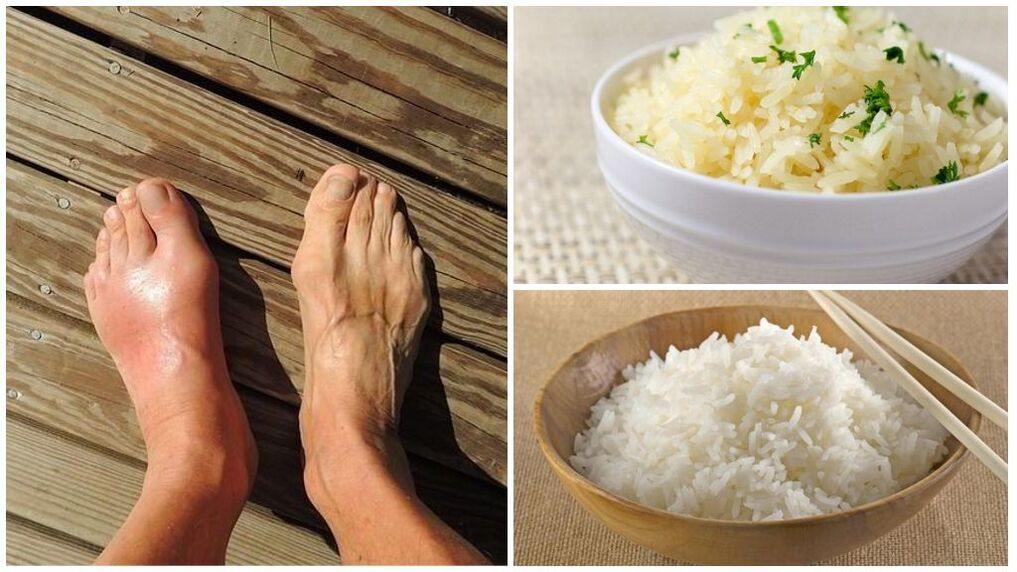 Gichtpatienten wird eine auf Reis basierende Diät empfohlen. 